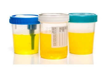 Eritrosit İdrar İdrarda Eritrosit Belirtileri Nelerdir?