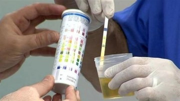 İdrar Tahlili Eritrosit Nedir?